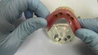 4Implant Ball Attachment Overdenture  Model Demonstration [upl. by Zondra70]