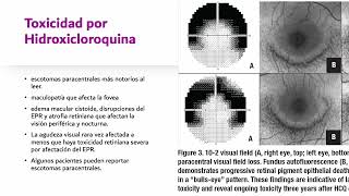 Plaquinol y cambios maculares Dra Salamanca [upl. by Ratcliff]