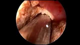 PCNL  Percutaneous Nephrolithotomy [upl. by Aikel]