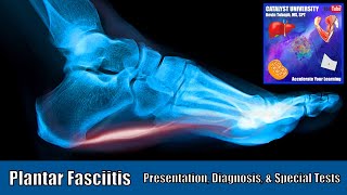 Plantar Fasciitis  Presentation Diagnosis amp Special Tests [upl. by Templa]