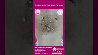 Treatment For Viral Warts On Scalp warts scalp drvimala drvimalamanne dermatologist [upl. by Freda]