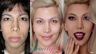 Facial feminization surgery before and after procedures [upl. by Anom182]