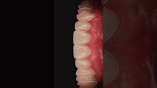 Rehabilitation for upper and lower jaw  إعادة تأهيل للفكين العلوي والسفلي [upl. by Senskell721]