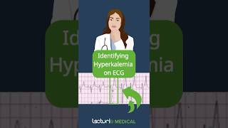 Key ECG Clues for Hyperkalemia 📊 [upl. by Levine]