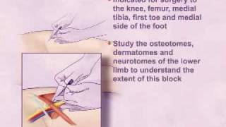 Single Injection Femoral Nerve Block [upl. by Sugden]