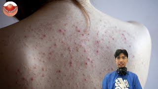 The MOST TERRIFYING Acne Squeezing Videos Youve Ever Seen 3 [upl. by Eliott]