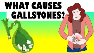 What Causes Gallstones Major Causes Of Gallstone Disease Gallstones Causes [upl. by Eulalia]