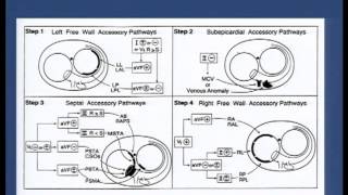 Pre  excitation syndromes  Dr Shashidhar 29092013 18 [upl. by Codee]