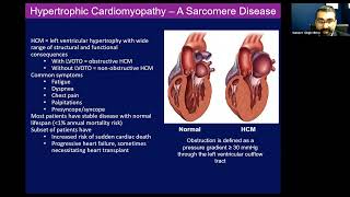 HFpEF Phenotypes HoCM and Cardiac Amyloidosis in 2023 [upl. by Dnyletak259]