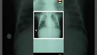 What Is Pulmonary Edema [upl. by Odella]