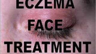 How To Treat Exzema Face  Exzema Face Remedies [upl. by Ellenyl]