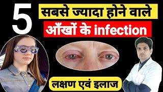 5 आंखों के common infection लक्षण और उनका इलाज  Eye infection [upl. by Assil]