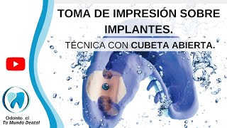 📋GUÍA PASO A PASO Impresión de implantes con cubeta abierta [upl. by Alieka807]