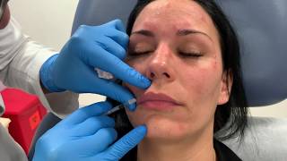 Nonsurgical lip lift using Botox or Dysport by Dr Shaun Patel in Miami FL  Botox Lip Flip [upl. by Barlow358]