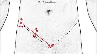 Surface marking of inguinal canal and its clinical correlations [upl. by Stanfield]