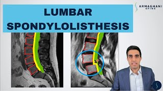 Lumbar Spondylolisthesis  Anatomy Symptoms Causes Treatments and more [upl. by Edrick640]