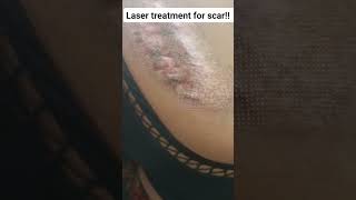 Banish Hypertrophic Scars The Power of CO2 Laser Treatment [upl. by Nibuz]