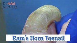 Rams Horn Toenail 2020 [upl. by Akenot]