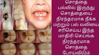 சொத்தை பல்லில் இருந்து நிரந்தரமாக சொத்தையை நீக்க இந்த மாதிரி செய்தால் போதும் [upl. by Ahmad105]