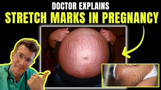 Doctor explains STRETCH MARKS in PREGNANCY  including signs clinical photos causes treatment [upl. by Yniatirb954]