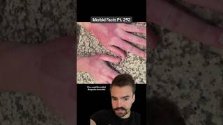 Margarita dermatitis is caused by WHAT morbidfacts [upl. by Arad664]