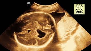 porencephalic cyst fetal ultrasound vs holoprosencephaly [upl. by Limbert]