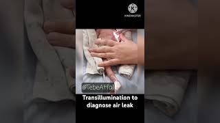 Transillumination to diagnose air leak l Pneumothorax neonatology [upl. by Barnum]