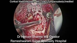 Unedited Cortical Mastoidectomy with Type 1 Tympanoplasty  Repair of Ear Drum  Ear Surgery [upl. by Ahsercel12]