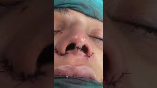 Rhinoplasty nose job in bangalore kolkata hyderabad Gurgaon new delhi mumbai pune indiadelhi mumbai [upl. by Kone830]