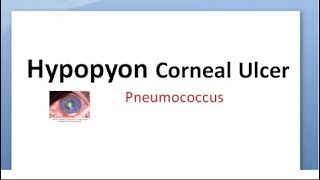 Ophthalmology 112 b Hypopyon Corneal Ulcer Strepcococcus pneumoniae Pneumococcus ulcus serpens [upl. by Elman803]