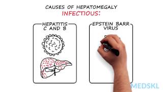 Gastroenterology – Hepatomegaly By Kelly Burak MD [upl. by Ermanno]