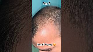 Regular using Derma roller and minoxidil hair solution  Hair Growth dermaroller [upl. by Eileen]