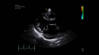 Mitral Valve prolapse and flail mitral leaflet in dog 🐕 [upl. by Odraleba491]