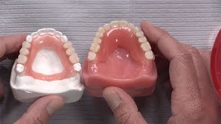 Case of the week Never Before Seen Partial Denture Material [upl. by Hutchings]