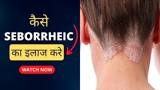 Seborrheic Dermatitis का इलाज  How To Treat Seborrheic Dermatitis कैसे seborrheic का इलाज करे [upl. by Falito]