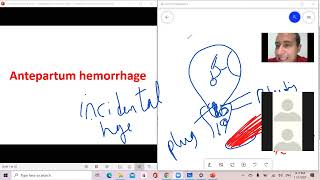 د السكري antepartum hemorrhage APH [upl. by Naimaj]