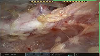 Tumor de Mediastino em Criança HD 720p [upl. by Apfel501]