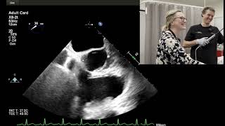 Aortic Valve Assessment with TOE [upl. by Yentrac]