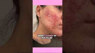 Did I Have Scar Treatments Post Accutane 👀 acne acnescars accutane [upl. by Mmada]