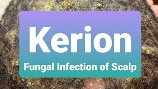 Kerion  Insight and Treatment [upl. by Ellednahs]