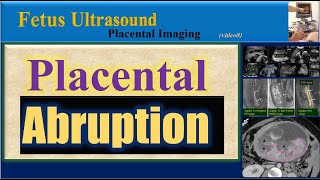 Fetus Ultrasound  Placental Abruption [upl. by Oster529]