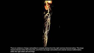 Klippel Trenaunay Weber Syndrome [upl. by Rodl]