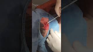 Epidermal Cyst Excision Neck [upl. by Aerdna]