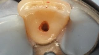 Internal resorption treatment with narration [upl. by Anairda]