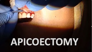 APICOECTOMY SURGERY STEPS IN APICOECTOMY INDICATIONS AND CONTRAINDICATIONS dentalcafe4331 [upl. by Lentha780]