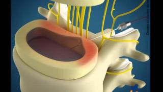 Animação Nucleoplastia por Radiofrequência [upl. by Fremont]