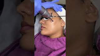 Carbon laser Skin lightening treatment Bhopal ✅Skin smile clinic carbon skismileckinic beauty [upl. by Smukler]