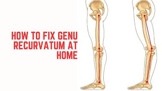 How to fix Genu RecurvatumHyperextended knee at home [upl. by Georgina]