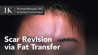 Treatment of Morphea en coup de sabre using Fat Transfer for forehead scar  Dr Hooman Khorasani [upl. by Atse391]