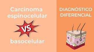 Diagnóstico Diferencial Carcinoma espinocelular vs basocelular [upl. by Danette]